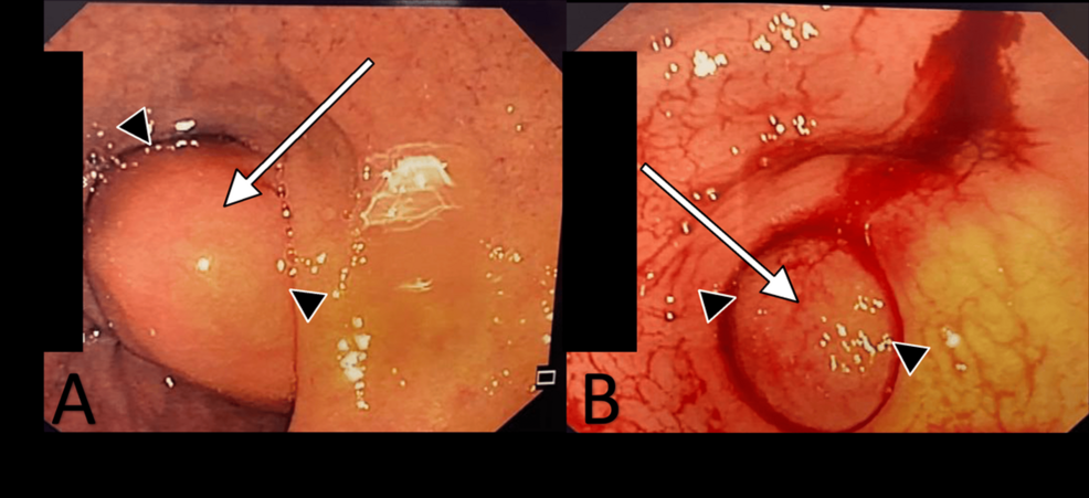 Large Duodenal Lipoma Causing Obstruction: A Case Report