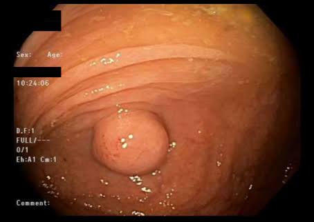 Medical publication visual for Beyond the Scope: Unmasking Appendicitis Following Colonoscopy