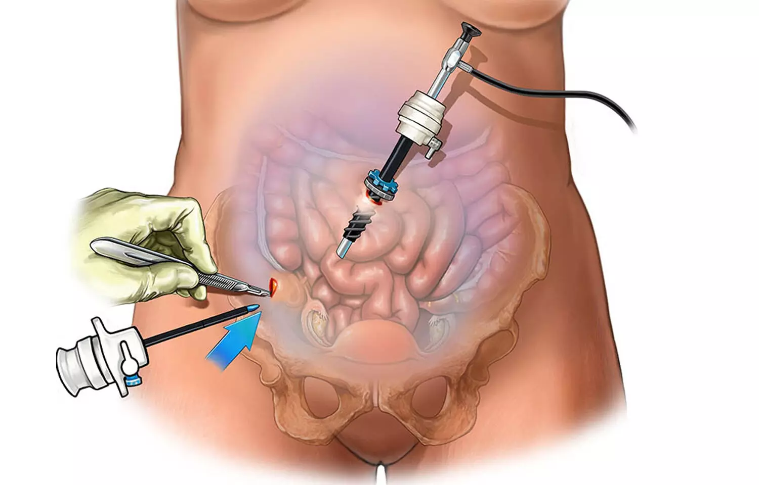 Medical publication visual for Diagnosis and Treatment of a 64-Year-Old Man with Chyle Leak Following Laparoscopic Cholecystectomy: A Case Report