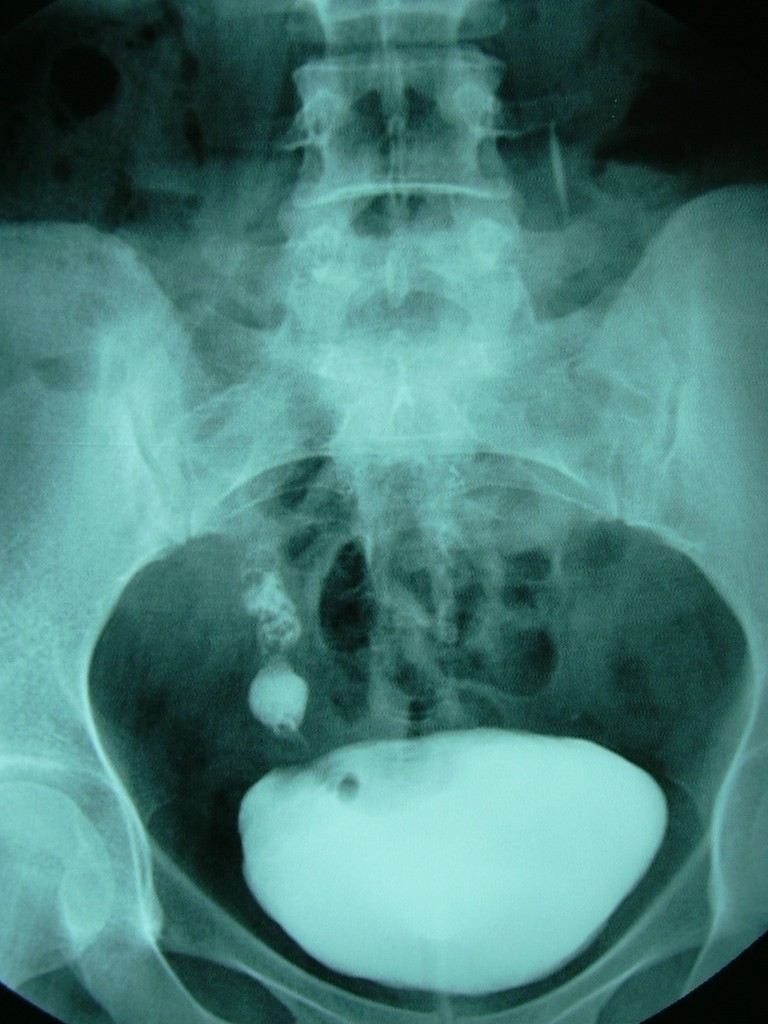 Medical publication visual for Giant Ureteral Fibroepithelial Polyp with Intermittent Prolapse Reaching the Urethral Meatus: A Case Report