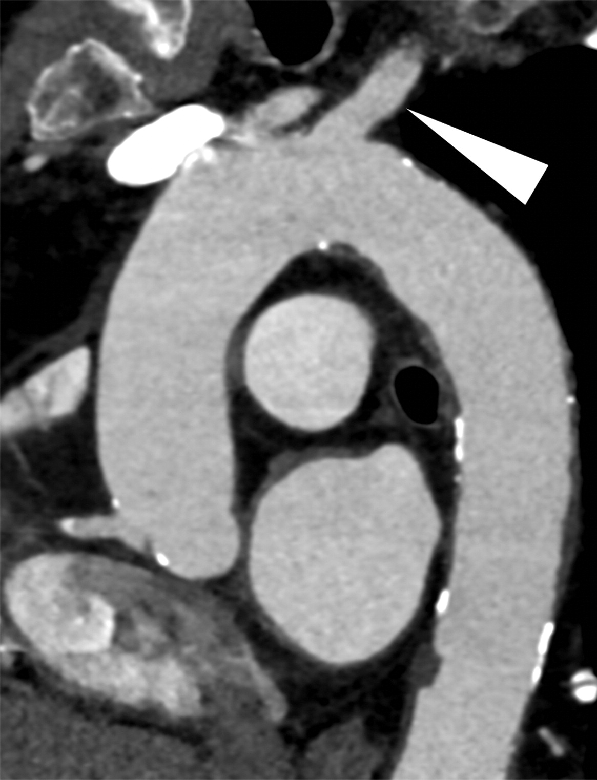 Medical publication visual for Iatrogenic Acute Ascending Aortic Dissection with Intramural Hematoma during Coronary Artery Stenting: A Case Report