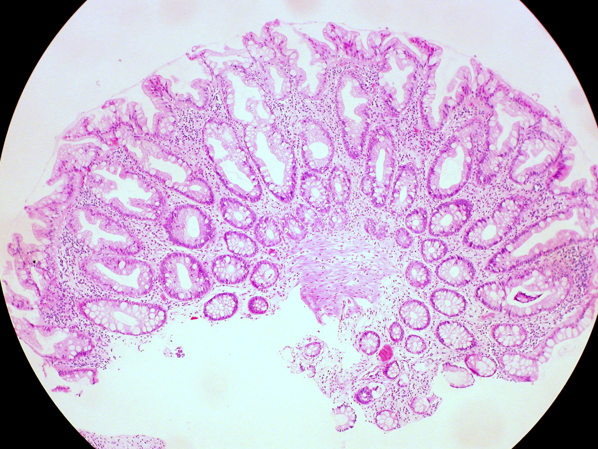 Medical publication visual for Incidental Diagnosis of Serrated Polyposis Syndrome of the Small and Large Bowel Treated Endoscopically and Surgically: A Case Report
