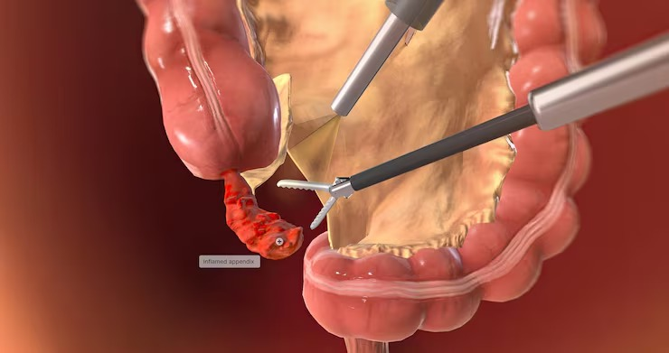 Medical illustration for Appendicitis & Appendectomy
