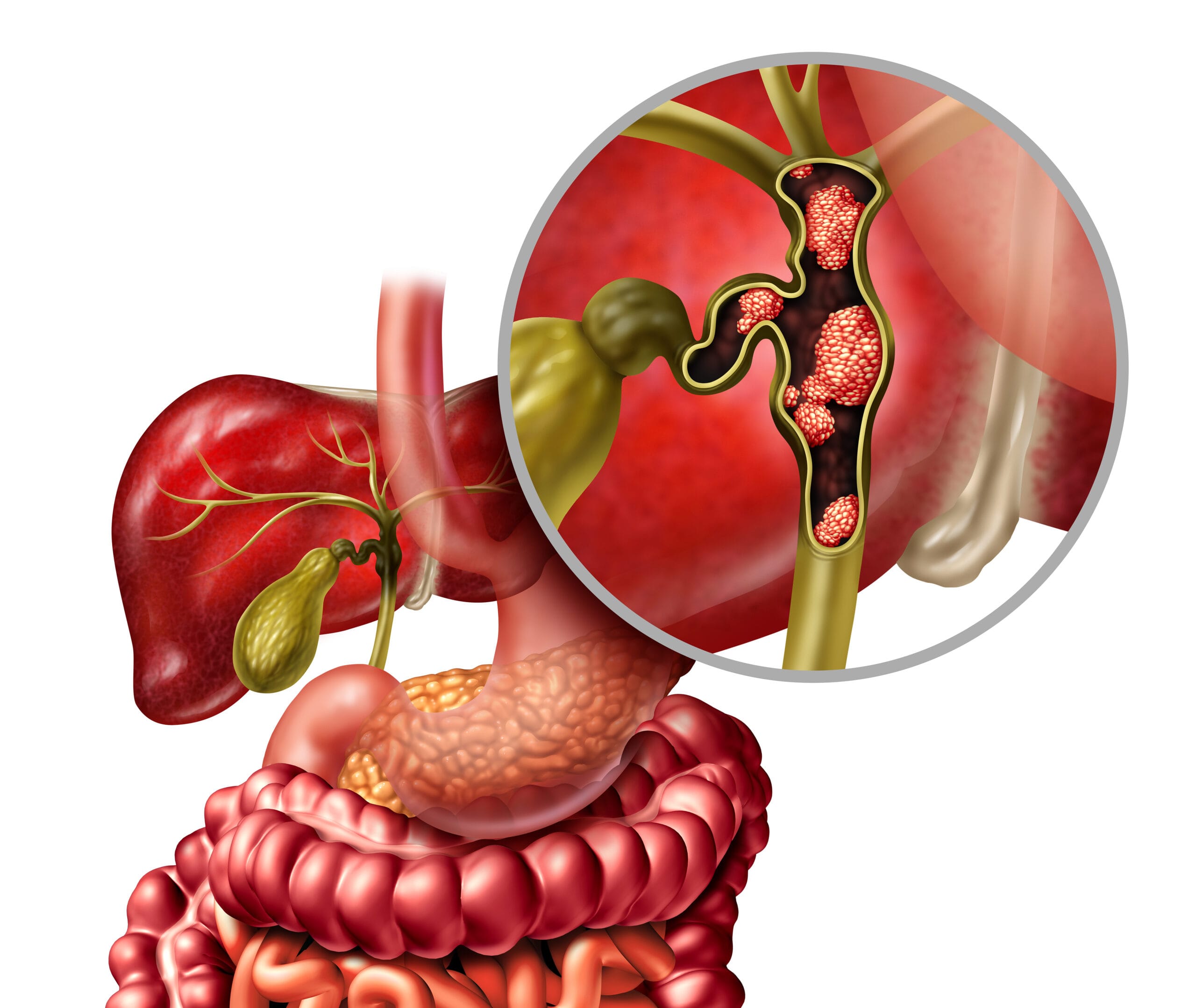 Medical illustration for Gallbladder & Bile Duct Cancer