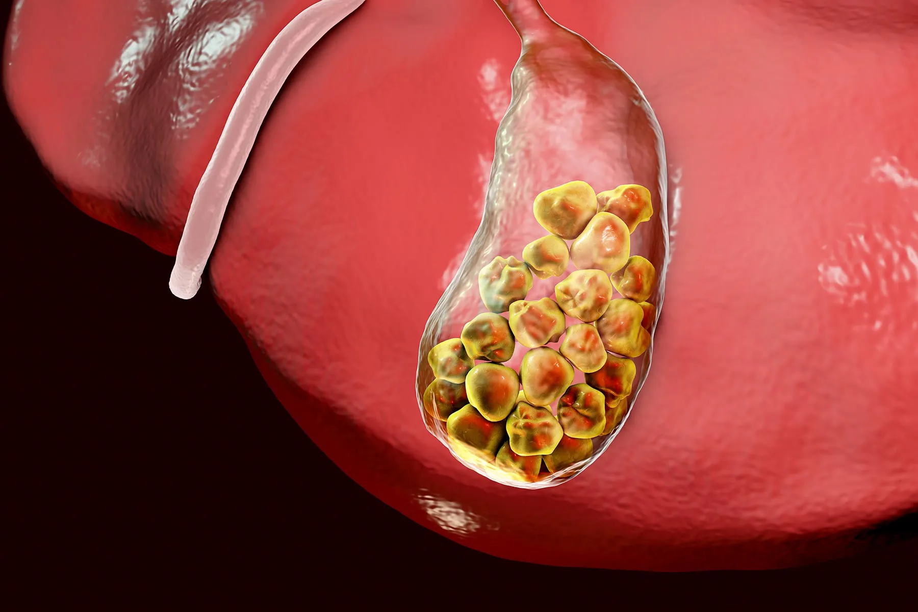 Medical illustration for Gallstones & Gallbladder Disease