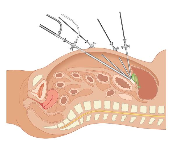 Minimally Invasive & Laparoscopic Surgery