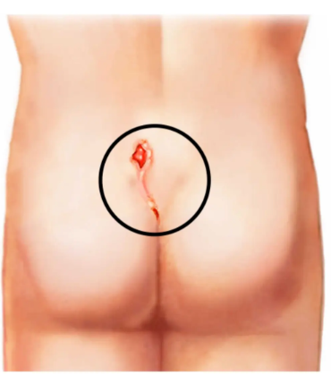 Medical illustration for Pilonidal Sinus